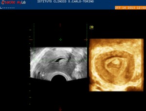 Sonoisterografia in 2-3D: caso di polipo nella cavità uterina